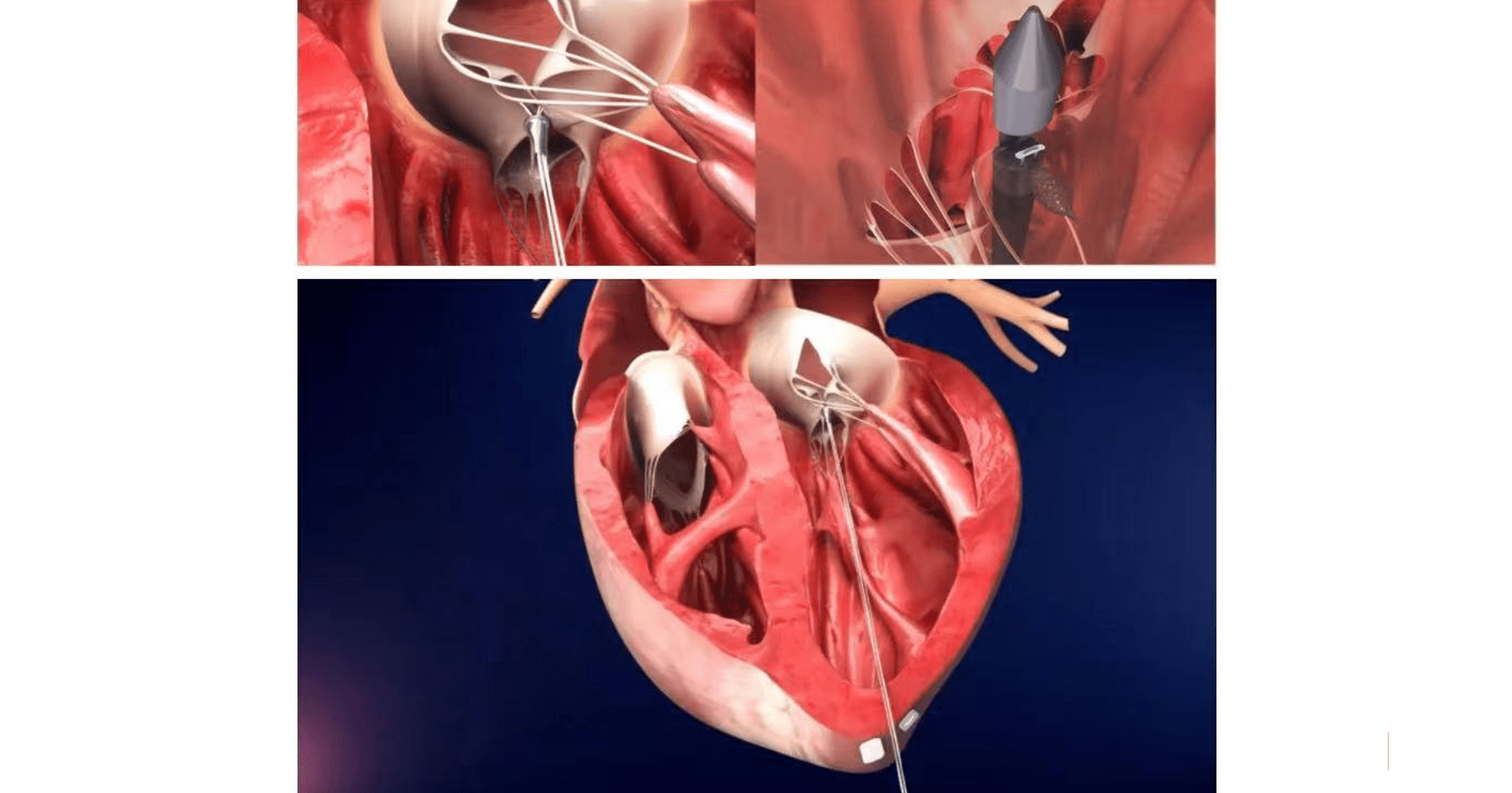 DCP, Sequoia China lead Series B round for medical devices firm Valgen